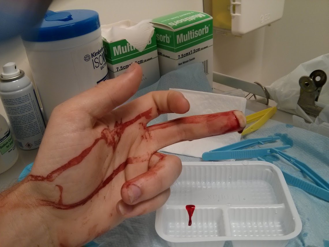 Cutting My finger up (1)