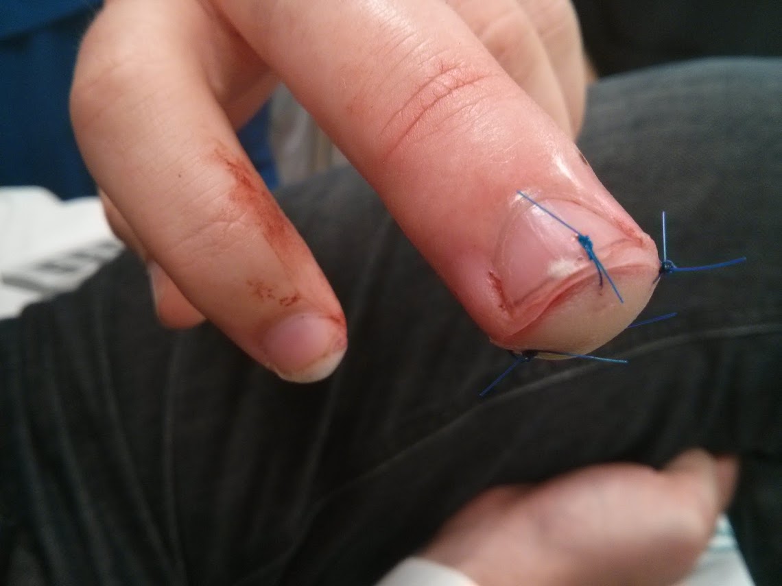 Cutting My finger up (7)